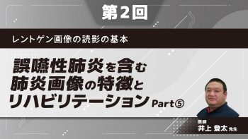 レントゲン画像の読影の基本 【第2回】誤嚥性肺炎を含む肺炎画像の特徴とリハビリテーション Part⑤誤嚥性肺炎2