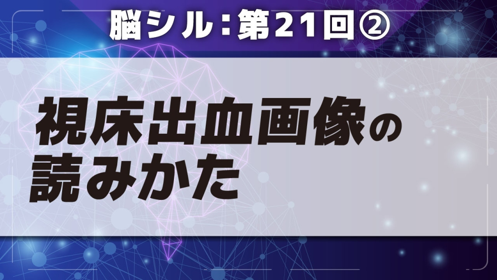 脳シル【第21回】被殻出血・視床出血の脳画像読影 Part②視床出血画像の読みかた