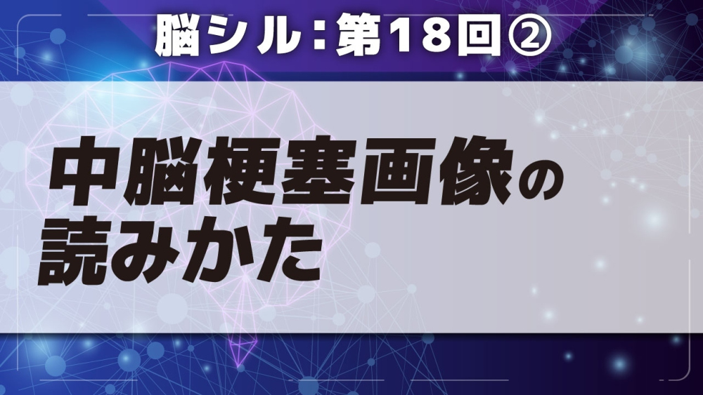 脳シル【第18回】小脳梗塞・中脳梗塞の脳画像読影 Part②中脳梗塞画像の読みかた