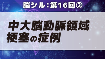 脳シル【第16回】中大脳動脈領域梗塞の脳画像読影 Part②中大脳動脈領域梗塞の症例