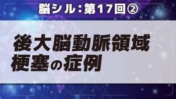 脳シル【第17回】後大脳動脈領域梗塞・内頸動脈領域梗塞・穿通枝動脈領域梗塞の脳画像読影 Part②後大脳動脈領域梗塞の症例