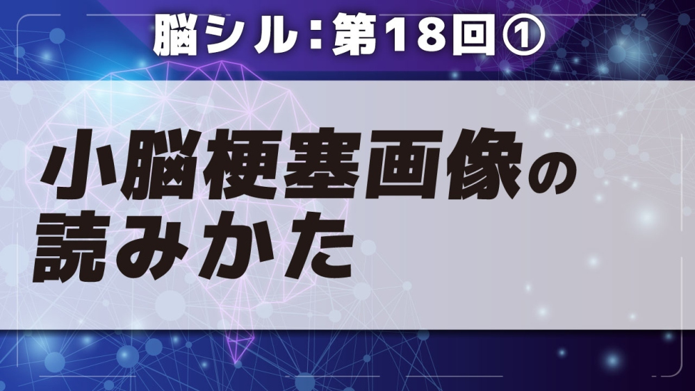 脳シル【第18回】小脳梗塞・中脳梗塞の脳画像読影 Part①小脳梗塞画像の読みかた